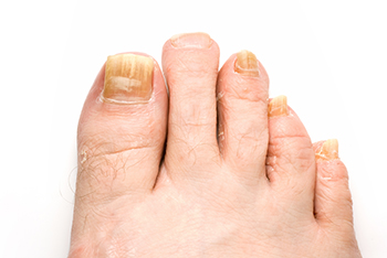 toenail fungus treatment in the Gahanna, OH 43230, Newark, OH 43055, Columbus, OH 43213, Pickerington, OH 43147, Lancaster, OH 43130, Dublin, OH 43016 and Westerville, OH 43082 areas