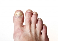 What Is The Medical Name For Toenail Fungus?