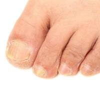 Tips for Preventing Toenail Infections