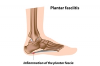 Treatment Options for Plantar Fasciitis