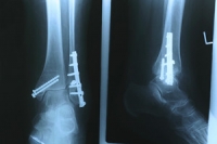 What Are Stress Fractures?