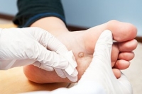 How to Spot a Plantar Wart on Your Child’s Feet