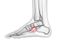 Foot Injuries and Cuboid Syndrome