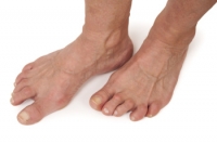 Recognizing Signs of Rheumatoid Arthritis in the Feet